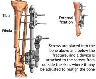 Tratamentul fracturii de gamba - fixator extern