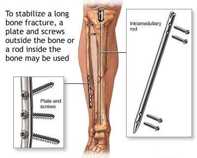 Tratamentul fracturii de gamba - fixator intern