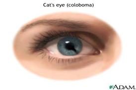 https://medicalimages.allrefer.com/large/cat-eye.jpg