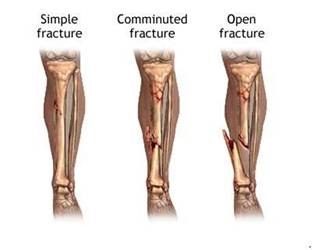 Fractura de tibie - tipuri